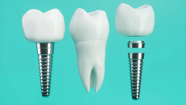 Diş implantı demonte--3d render
