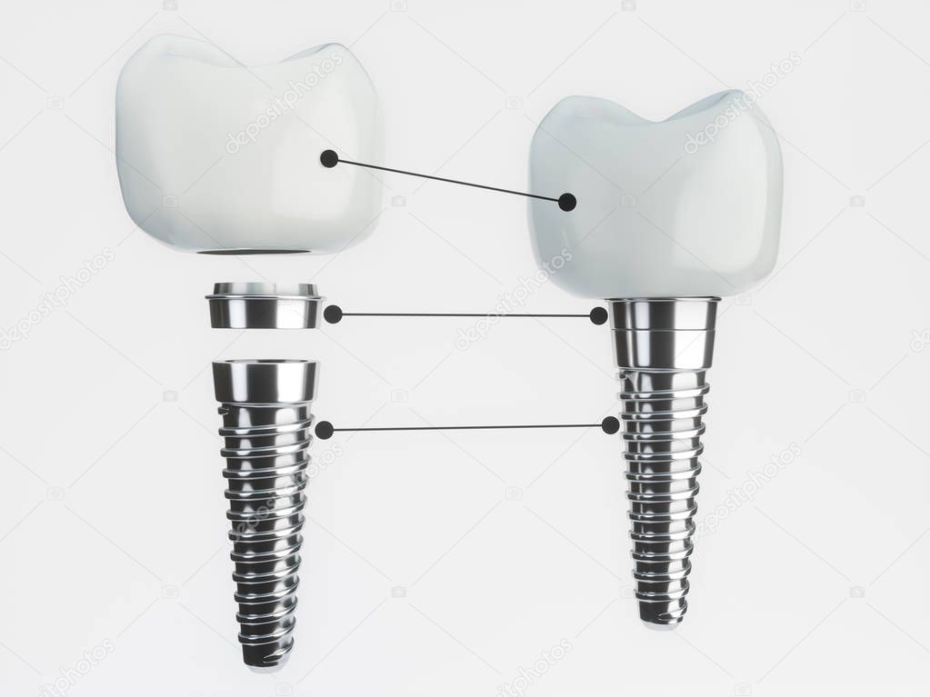 Tooth implant disassembled -- 3D Rendering