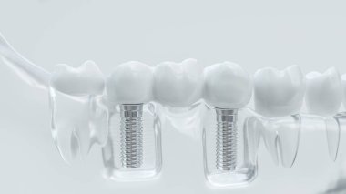 Şeffaf bir çene implantlarında