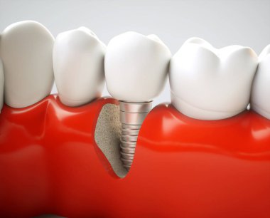 Dental implant on the example of a jaw model - 3D rendering clipart