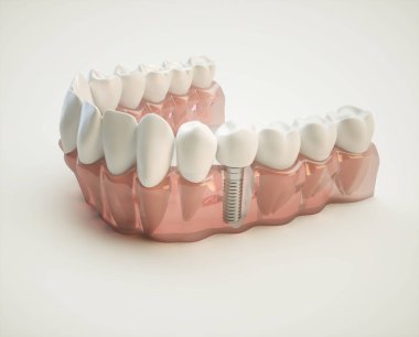 Dental implant on the example of a jaw model clipart