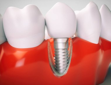 Bir çene modeli örneğinde diş implantı - 3B oluşturma