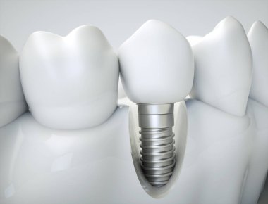 Bir çene modeli örneğinde diş implantı