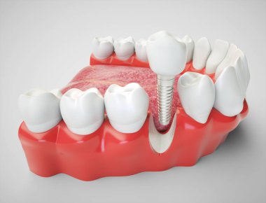 Bir çene modeli örneğinde diş implantı - 3B oluşturma