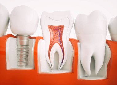 Sağlıklı dişler ve bir implant - 3d render