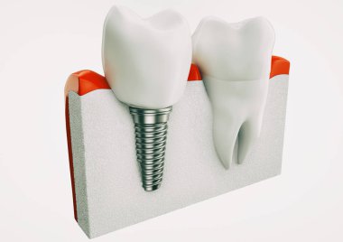 sağlıklı dişler ve diş implant çene kemiği anatomisi.