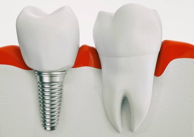 sağlıklı dişler ve diş implant çene kemiği anatomisi.