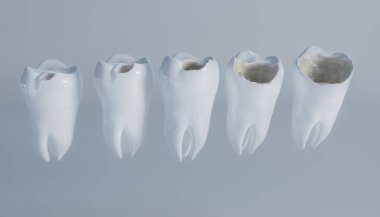 Çürük azı üzerinde--aşamaları 3d render