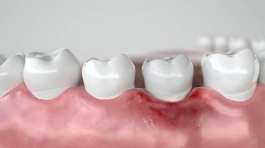 Çürük, üç aşamalı - Aşama 1 Gingivitis--3d render