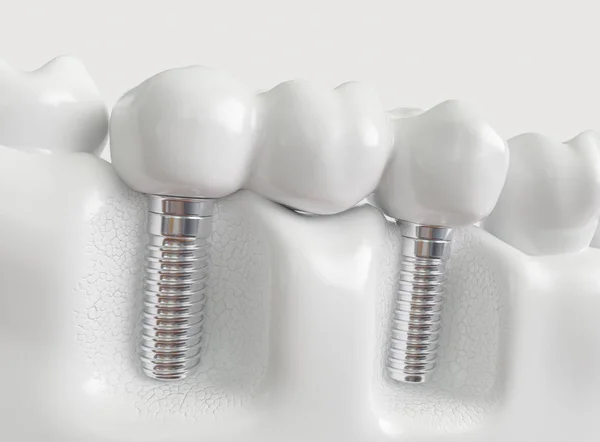 Implantes Com Ponte Dentária Renderização — Fotografia de Stock