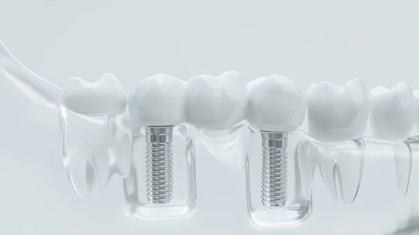 Şeffaf bir çene implantlarında
