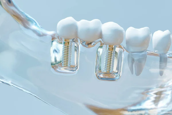 Implante Humano Dental Representación — Foto de Stock