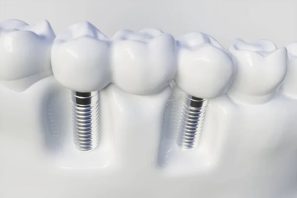 Ząb Człowieka Implantu Renderowania — Zdjęcie stockowe