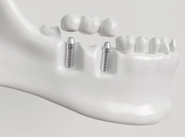 Implantaten Met Dental Bridge Rendering — Stockfoto