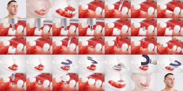 In this sequence of an implant operation you will see all the steps for using a dental implant. The pictures was created with the greatest possible care.