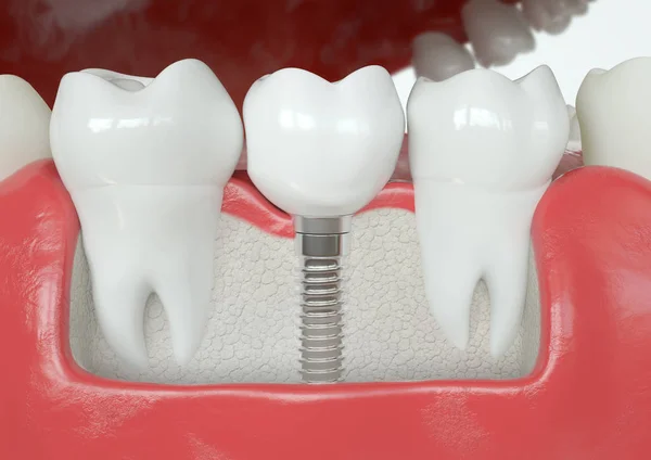 Sağlıklı vs diş implantı--3d Rendering