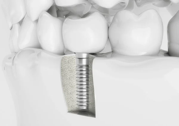 Impianto Umano Dei Denti Concetto Dentale Denti Protesi Umane Rendering — Foto Stock