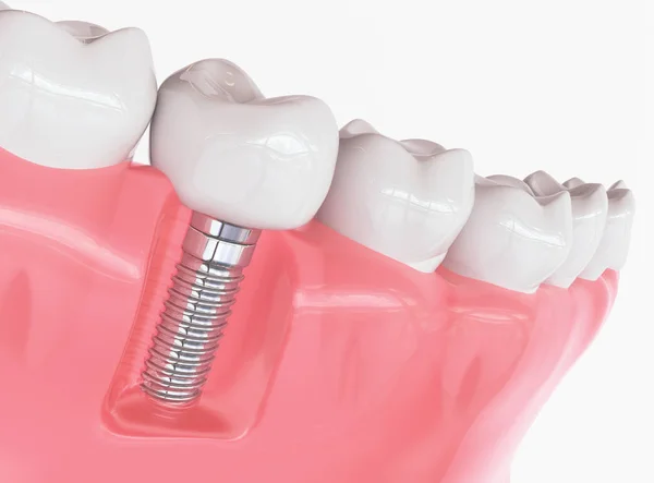 Implant Dentaire Humain Concept Dentaire Dents Prothèses Dentaires Humaines Rendu — Photo