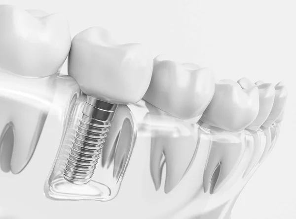 İnsan implant diş. Diş kavramı. İnsan diş ya da protez. 3D render
