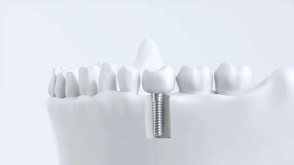 Człowieka Implantu Zęba Koncepcja Dentystycznych Zębów Ludzkich Lub Protezy Renderowania — Zdjęcie stockowe