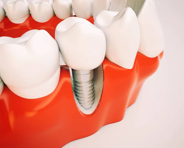 Tandheelkundig Implantaat Het Voorbeeld Van Een Kaakmodel Rendering — Stockfoto