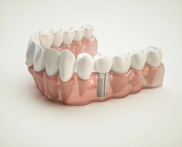 Implante Dentário Exemplo Modelo Mandíbula — Fotografia de Stock