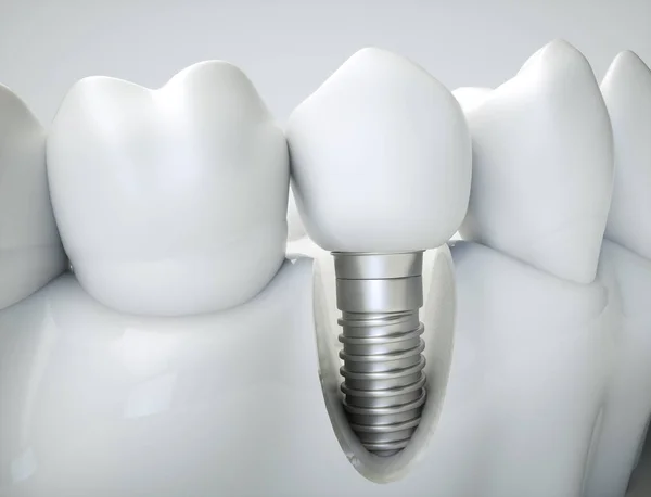 Bir çene modeli örneğinde diş implantı