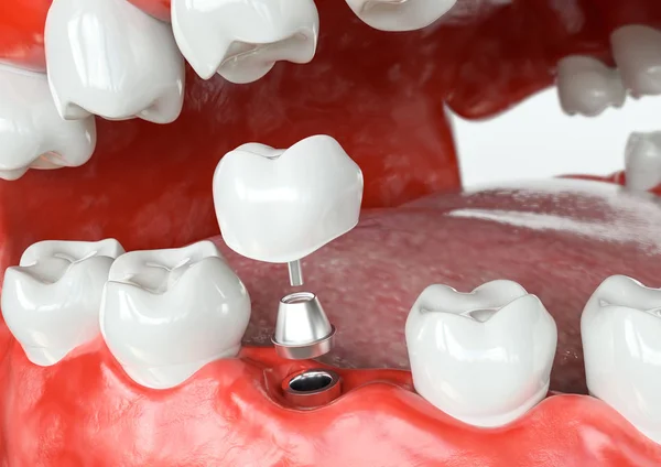 Implante Humano Dental Antes Concepto Dental Dientes Humanos Prótesis Dentales —  Fotos de Stock