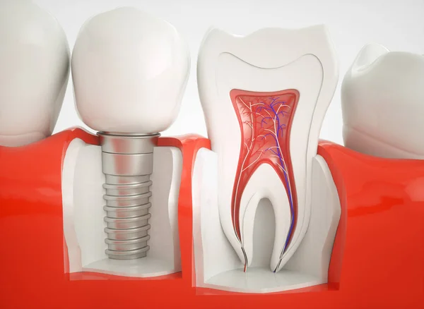 Sağlıklı dişler ve bir implant - 3d render