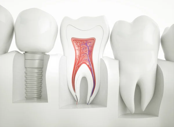 健康な歯とインプラント レンダリング — ストック写真