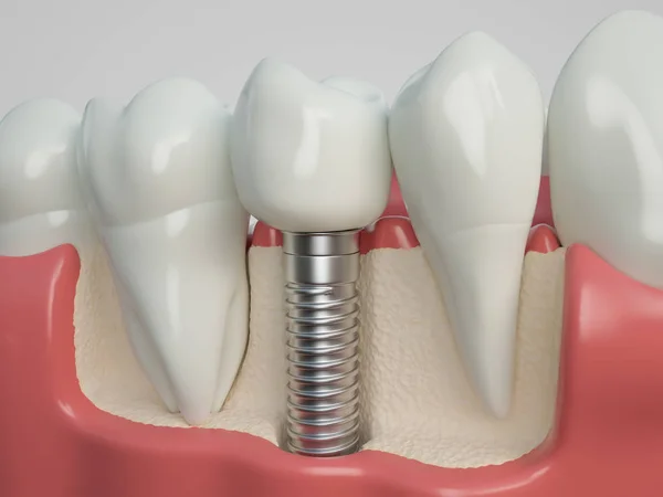 İnsan implant diş. Diş kavramı. İnsan diş ya da protez. 3D render