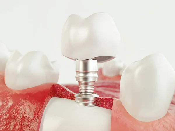 人間のインプラントを歯します 歯科のコンセプトです 人間の歯や入れ歯 レンダリング — ストック写真