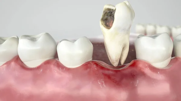 Caries in three stages - Stage 3 tooth extraction -- 3D Rendering