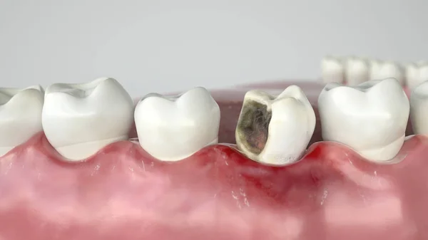 Caries in three stages - Stage 2 strong caries attack -- 3D Rendering