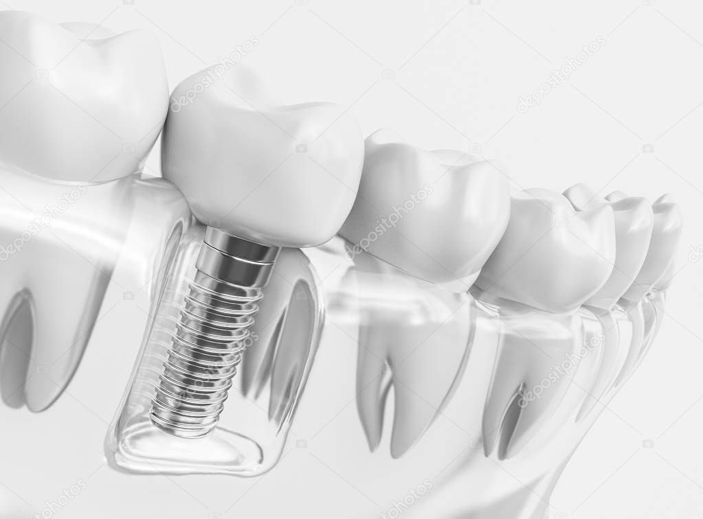 Tooth human implant. Dental concept. Human teeth or dentures. 3d rendering