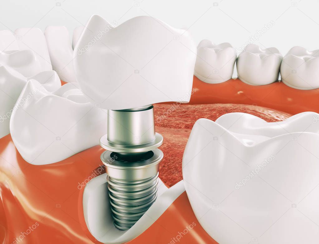 Dental implant on the example of a jaw model - 3D rendering