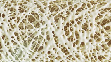 Osteoporoz - yüksek detaylar - Stage 4--3B oluşturma Gelişmiş