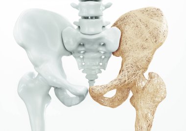 Osteoporoz üst ekstremite kemikleri - insan vücudu