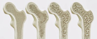 Osteoporoz 4 Etap--3d render