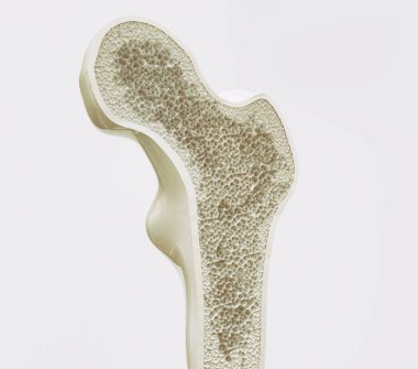 Osteoporoz aşama 4 - 3 boyutlu görüntüleme