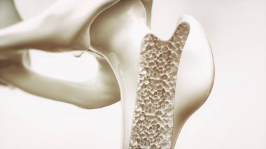 4 - üst ekstremite kemikleri osteoporoz evre 4
