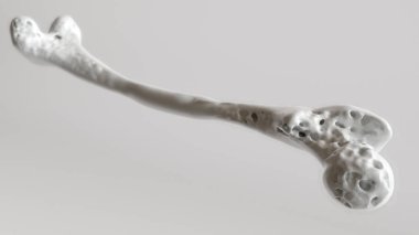 4 - üst ekstremite kemikleri osteoporoz sahne 3