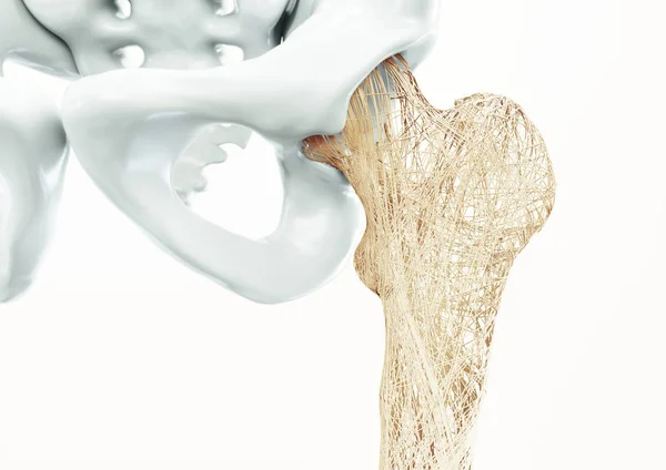 Osteoporosis Upper Limb Bones Human Body — Stock Photo, Image