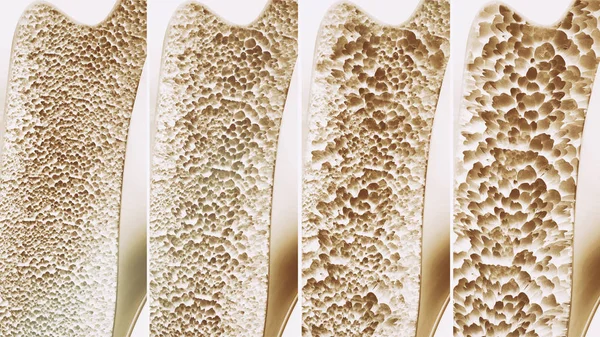 骨粗しょう症4 1枚の写真の段階 3Dレンダリング — ストック写真