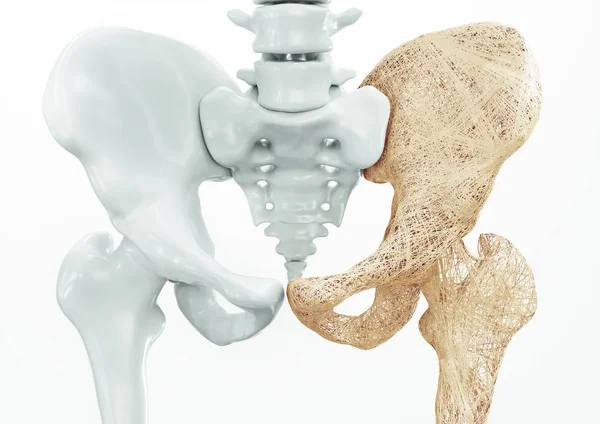 Osteoporose Dos Ossos Dos Membros Superiores Corpo Humano — Fotografia de Stock