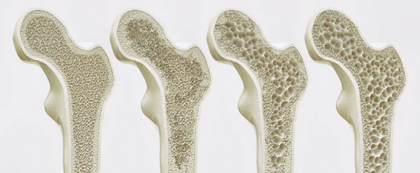 骨质疏松症4个阶段 — 图库照片