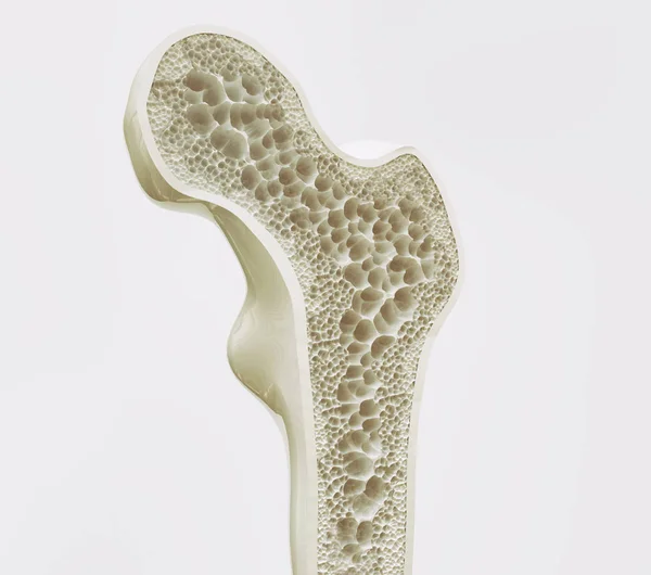 Osteoporosis Stage Rendering — Stock Photo, Image