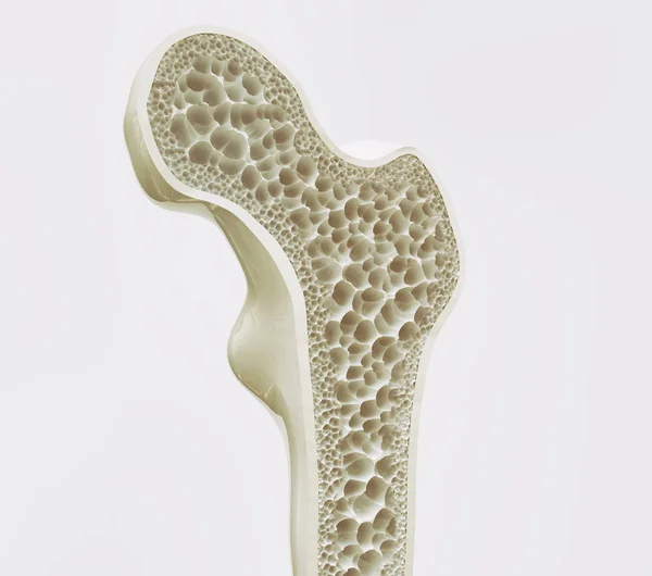 Osteoporosis Szakaszban Renderelés — Stock Fotó