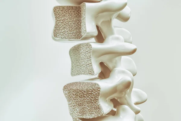 Osteoporosis Columna Vertebral Renderizado —  Fotos de Stock