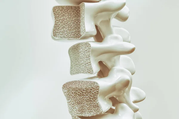 Osteoporosi Sulla Colonna Vertebrale Rendering — Foto Stock